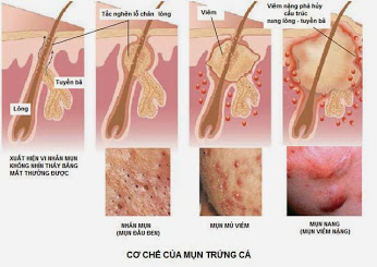 Trị mụn trứng cá tuổi dậy thì