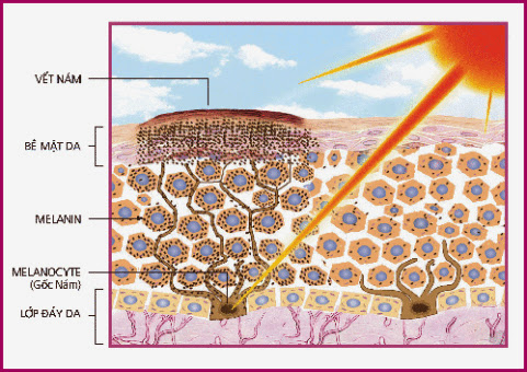 Nám da và cách trị nám da