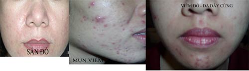 tri mun bang corticoid