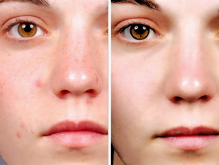 Các cách trị mụn hiện nay . tri mun