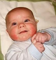 Trị nám da hiệu quả