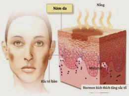 Trị nám da tại nhà