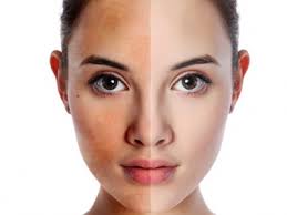 Cách trị nám da với lá trầu không